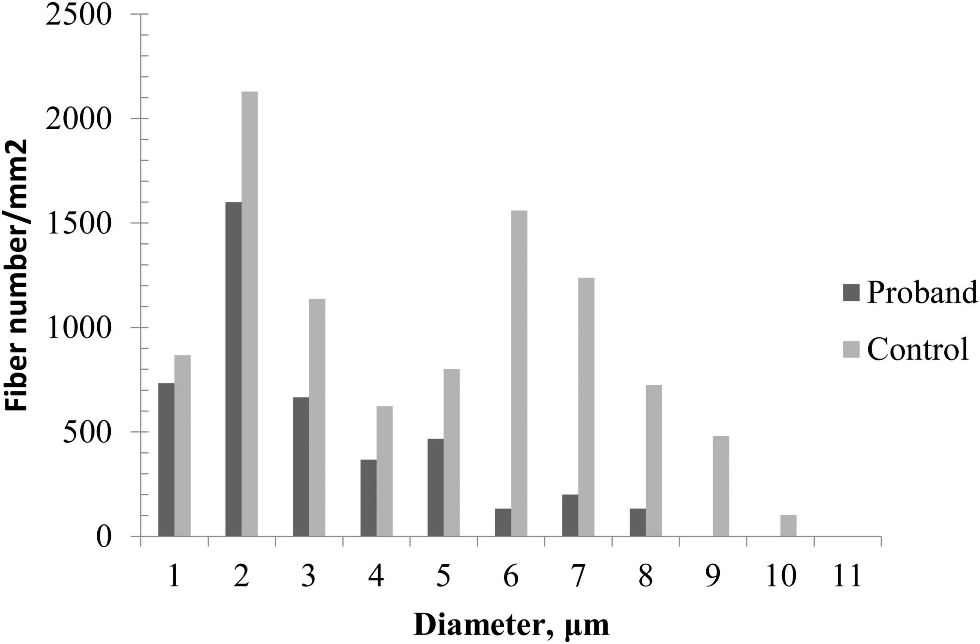 Histogram comparing fiber diameter distribution between proband and age-matched control, demonstrating a unimodal pattern with loss of large myelinated fibers and reduced fiber density in the proband.