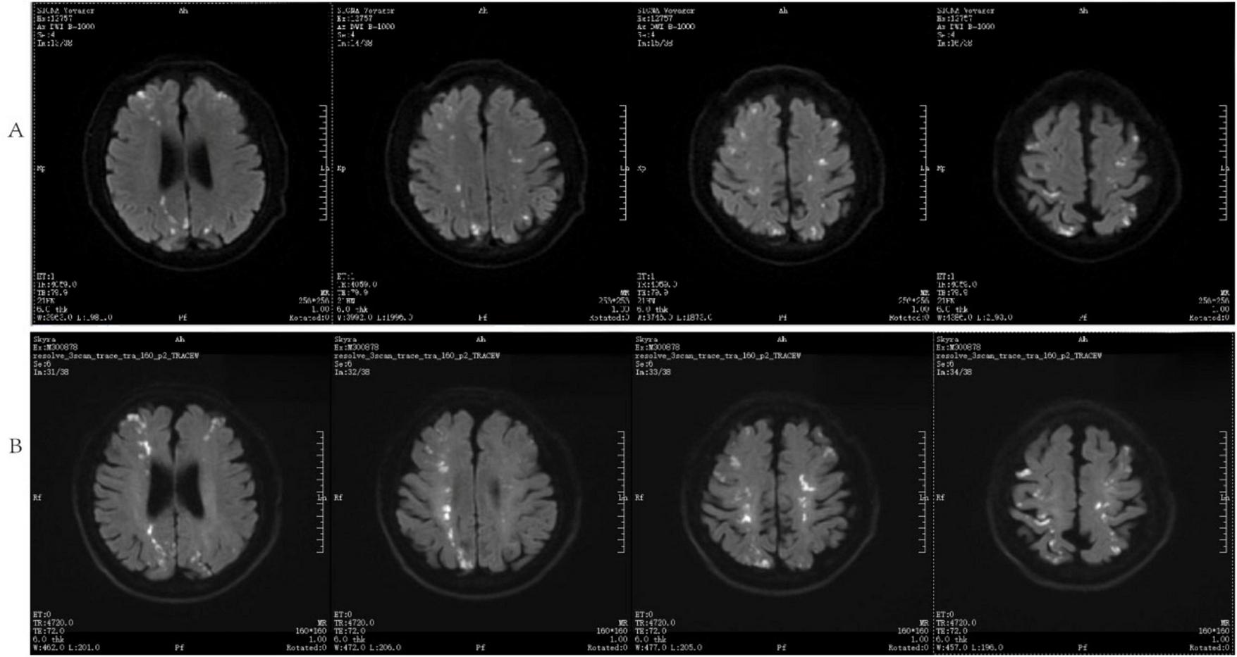 MRI brain scans in two rows labeled A and B. Both rows display four axial view images showing different brain sections, highlighting white matter and regions of interest. Each scan includes technical parameters on the edges.