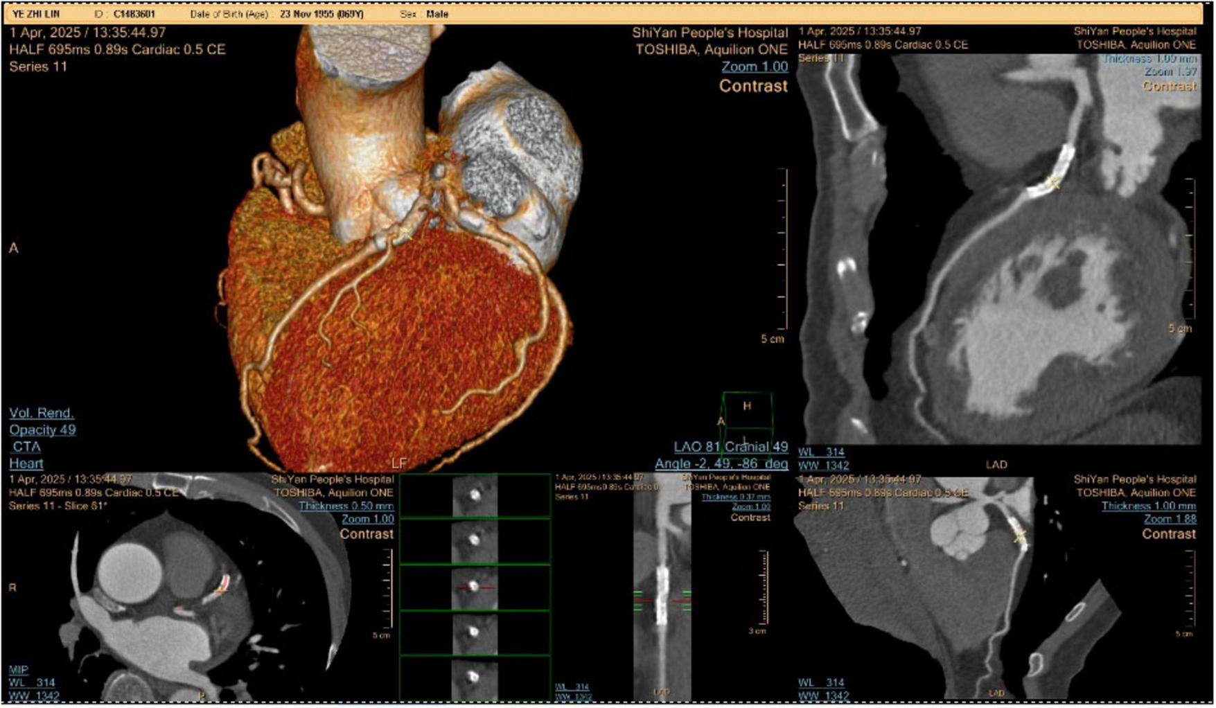 Composite image showing multiple views of a heart using computed tomography angiography (CTA). The top left displays a 3D colored representation with highlighted arteries. Other sections display black and white cross-sectional views highlighting different angles and sections of the heart. Labels and measurements appear throughout, indicating a detailed coronary analysis.