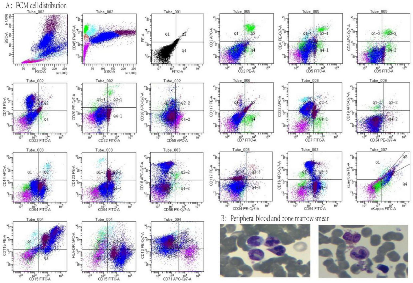 Flow cytometry plots and smears of peripheral blood and bone marrow are shown. Section A depicts cell distributions across various tubes with scatter plots. Section B shows microscopic images of blood smears with visible cells.
