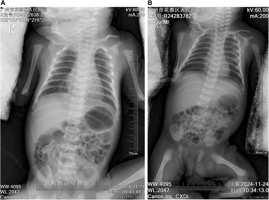 Two pediatric chest X-rays labeled A and B show the skeletal structure, including ribs and spine. The abdominal area reveals gas patterns, with measurements indicated on the side.