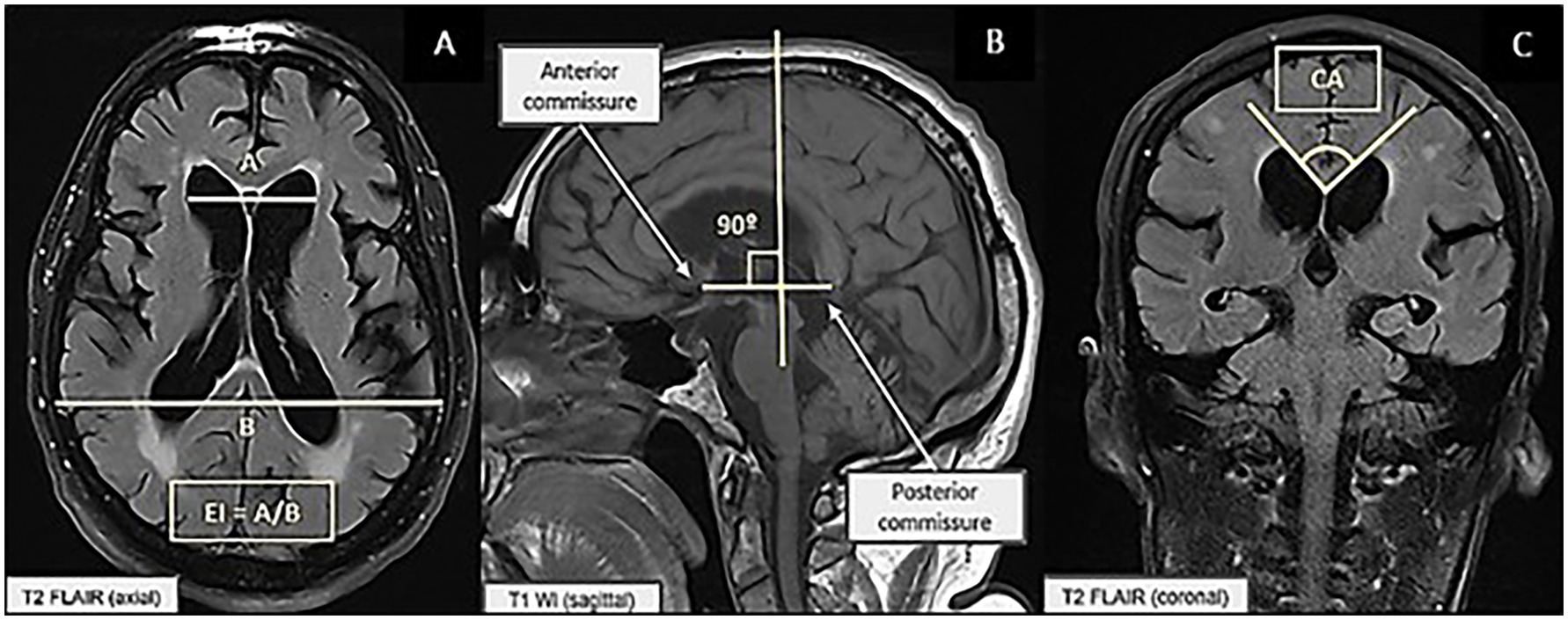 Three MRI brain scans are shown. Image A is an axial T2 FLAIR scan with lines measuring distances A and B, showing the Evans Index (EI = A/B). Image B is a sagittal T1 weighted scan highlighting the anterior and posterior commissures with a 90-degree angle marker. Image C is a coronal T2 FLAIR scan with a highlighted region labeled CA, focusing on ventricular structures.