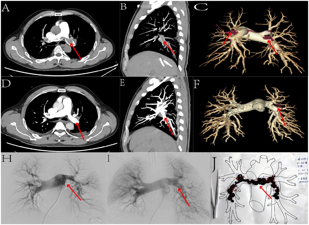 CT and angiographic images showcasing pulmonary blood vessels with red arrows highlighting specific areas. Panels A, B, D, and E display cross-sectional views of the chest. Panels C and F present 3D reconstructions of the vascular tree. Panels H and I show angiograms with visible vessels and highlighted regions. Panel J includes a schematic diagram with marked areas.