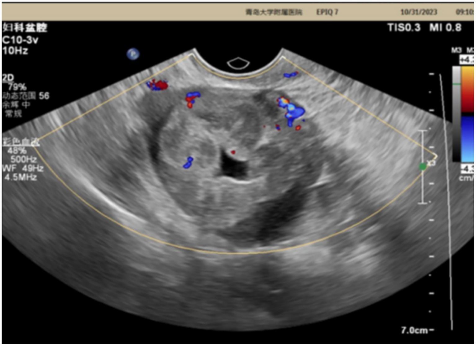 Ultrasound image displaying a grayscale pelvic scan with highlighted areas in red and blue, indicating blood flow. Text overlays with frequency and settings information are visible, along with a color scale on the right.