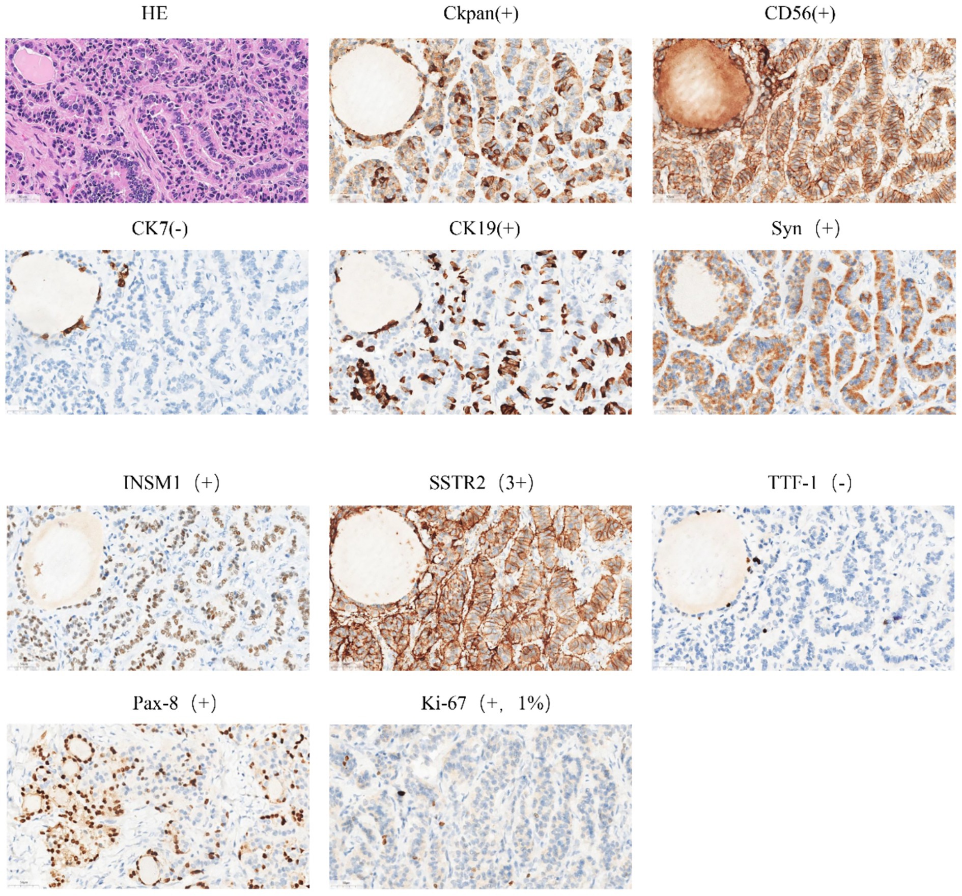 Histological slides display various immunohistochemistry stains of a tissue sample. Stains include HE, Ckpan, CD56, CK7, CK19, Syn, INSM1, SSTR2, TTF-1, Pax-8, and Ki-67, showing positive and negative results for each marker.