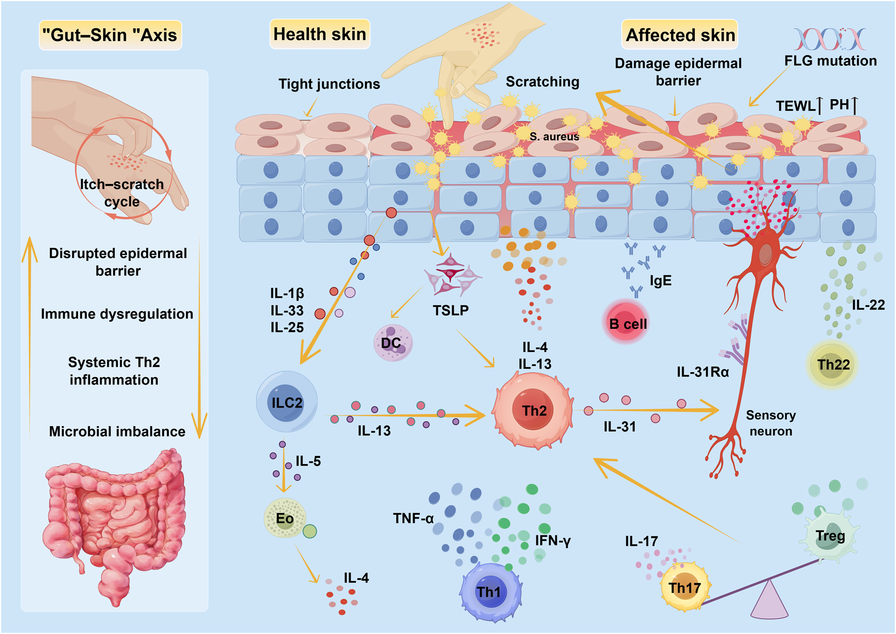 Diagram illustrating the “Gut-Skin” axis and differences between healthy and affected skin. The healthy skin shows intact tight junctions. Affected skin has disrupted barriers, microbial imbalance, and immune dysregulation due to scratching and filaggrin (FLG) mutation. Various cytokines and immune cells such as ILC2, Th2, and Th17 are involved, leading to inflammation and itch-scratch cycle. The diagram highlights interactions between the skin and immune system, emphasizing the impact of cytokines like IL-1β, IL-13, and IL-22 on skin health.