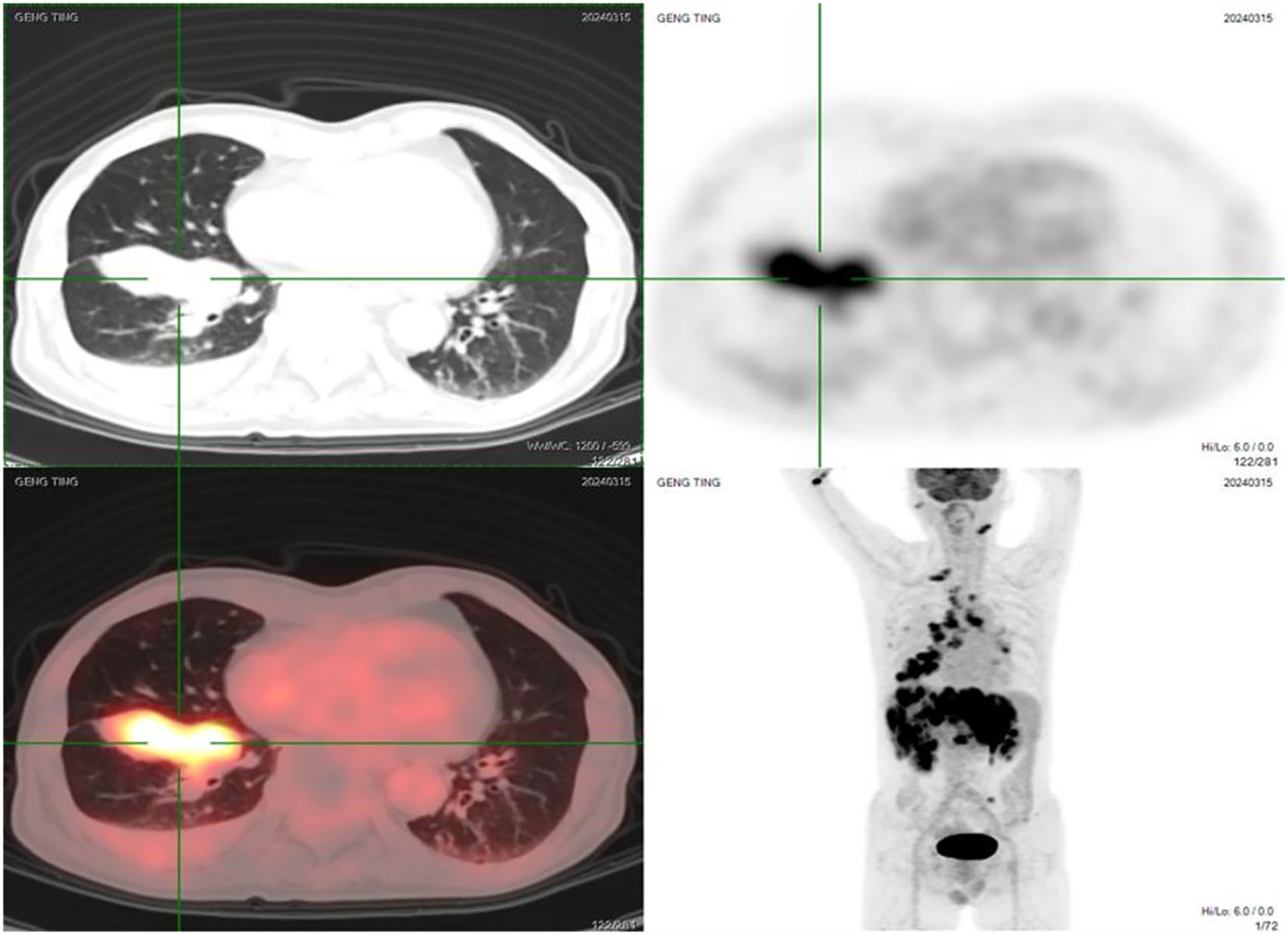 CT and PET scan images display cross-sectional views of a chest and a full-body scan. Top left shows a black-and-white chest CT scan, while the bottom left presents the corresponding PET scan with colored highlights. The top right is a blurred PET scan cross-section, and the bottom right is a full-body PET scan showing darkened areas. Green crosshairs pinpoint specific locations in each scan.