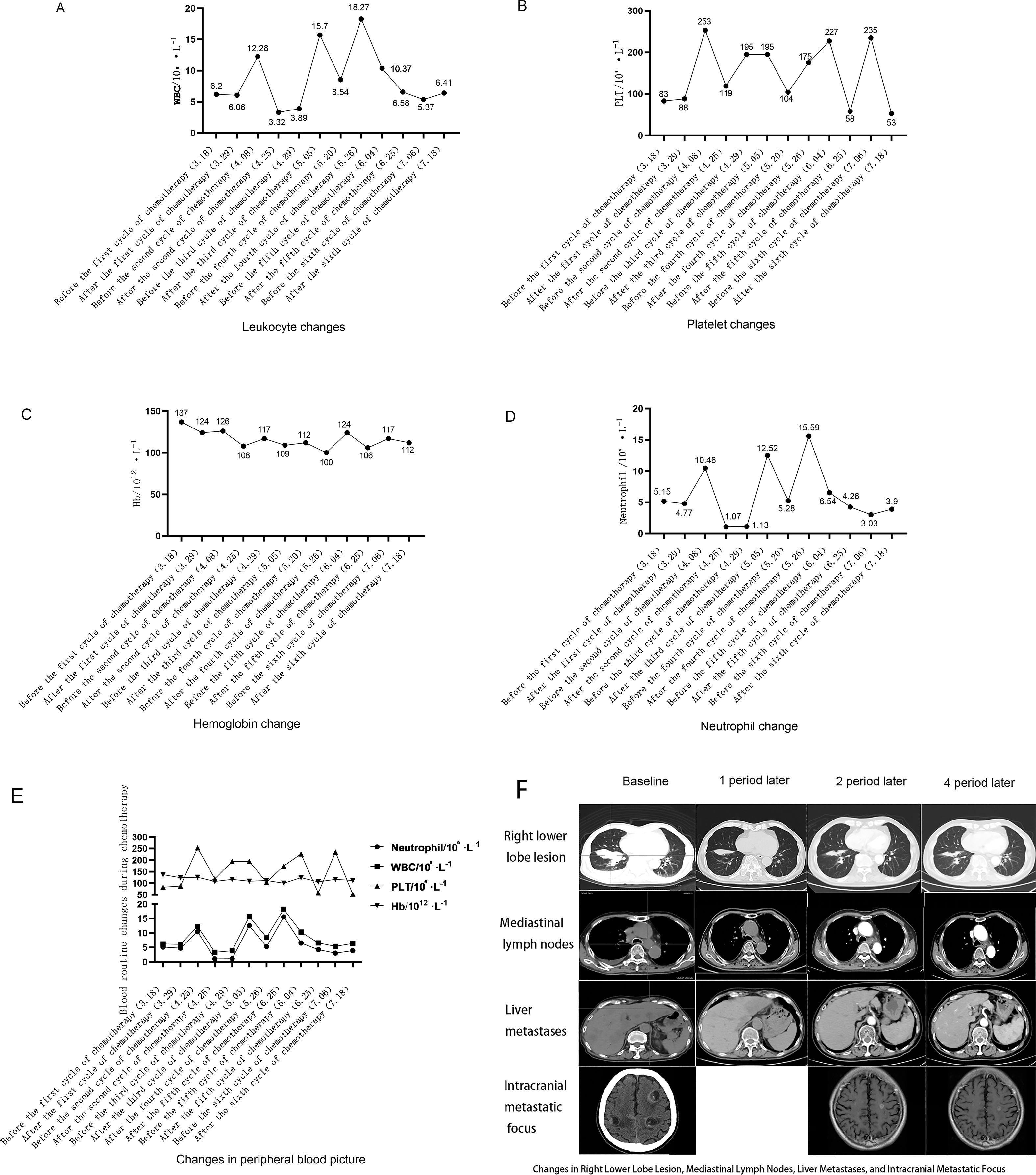 Five graphs and one image set are displayed. The graphs show changes in leukocytes, platelets, hemoglobin, neutrophils, and combined peripheral blood changes over time, with fluctuations marked by peaks and troughs on each line graph. The image set features CT scans showing lesions in the right lower lobe, mediastinal lymph nodes, liver metastases, and intracranial metastatic focus at baseline and subsequent periods. The graphs and scans illustrate the progression and changes in a patient's blood parameters and tumor presence.