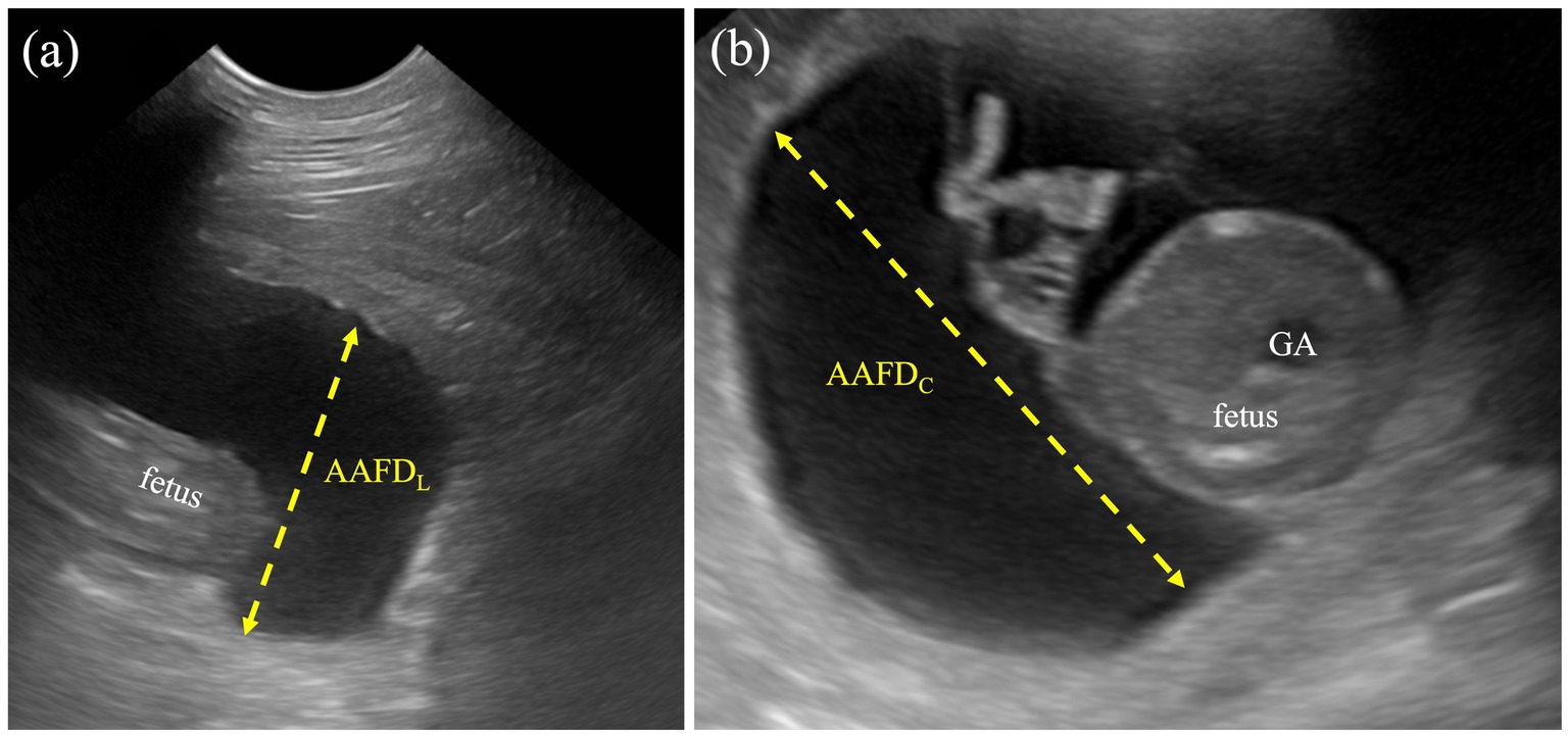Ultrasound image showing two panels. Panel (a) depicts a fetus with a yellow dashed line labeled AAFDL. Panel (b) shows a fetus labeled
