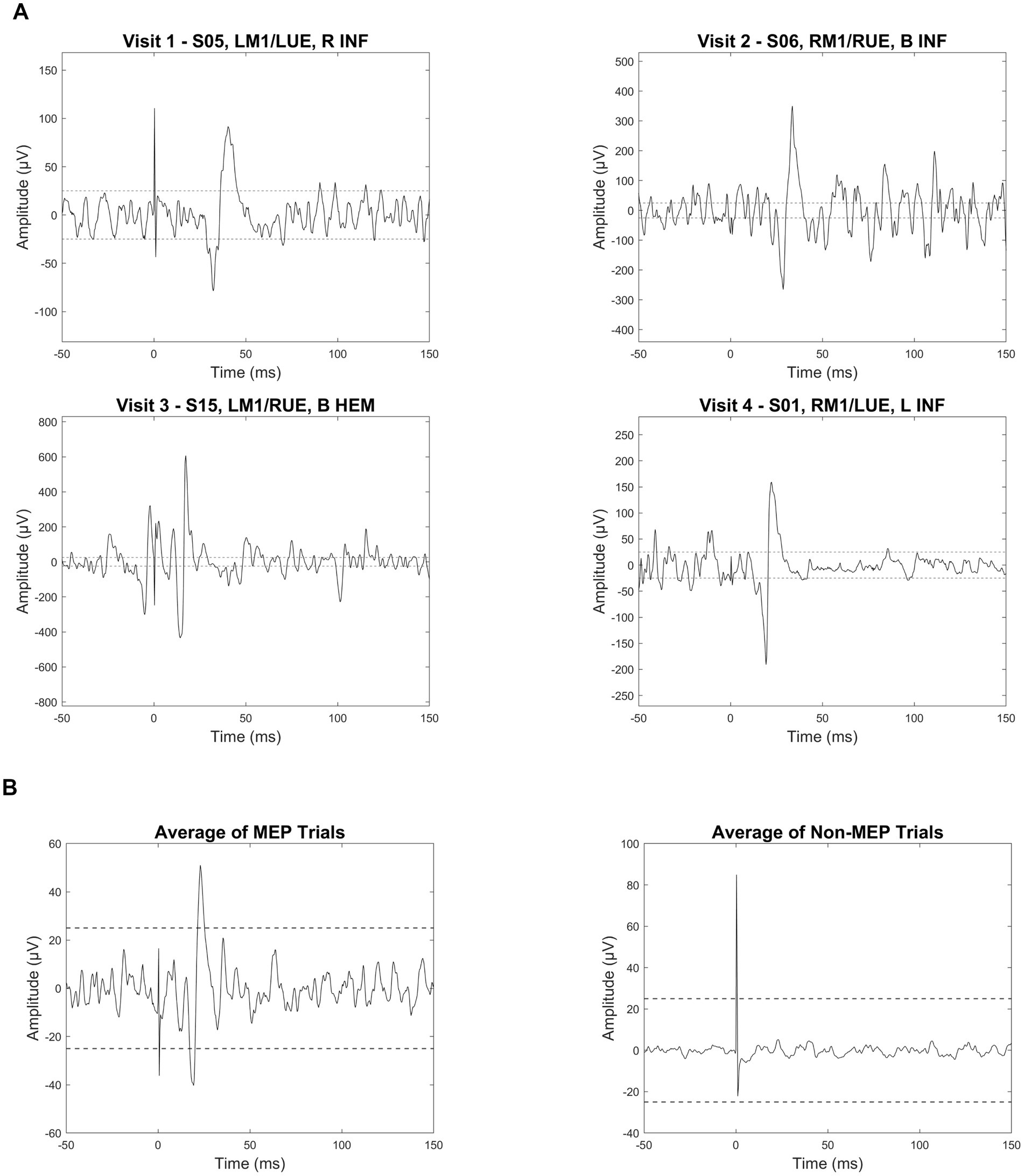 A two-panel figure illustrating the characteristics of a positive motor-evoked potential (MEP). Panel A shows four example EMG traces defined as positive MEPs because they are visually distinct from background noise and have a peak-to-peak amplitude exceeding 50 microvolts. This sharp deflection occurs between 10 and 50 milliseconds post-stimulus. Part B shows two average waveforms, contrasting the distinct peak of positive MEP trials with the relatively flat, noisy line of non-MEP trials.