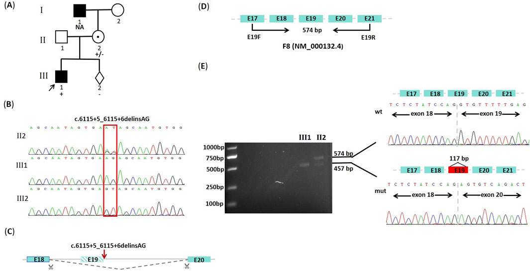 Diagram illustrating genetic analysis. (A) Pedigree chart shows family members with and without a mutation. (B) DNA sequencing results highlight the c.6115+5_6115+6delinsAG mutation. (C) Schematic of gene showing exon structure affected by the mutation. (D) Exon layout of the F8 gene with loci of exons E17 to E21. (E) Gel electrophoresis image shows DNA fragment sizes for two individuals, with schematic detailing exon changes between wild type (wt) and mutant (mut) alleles.