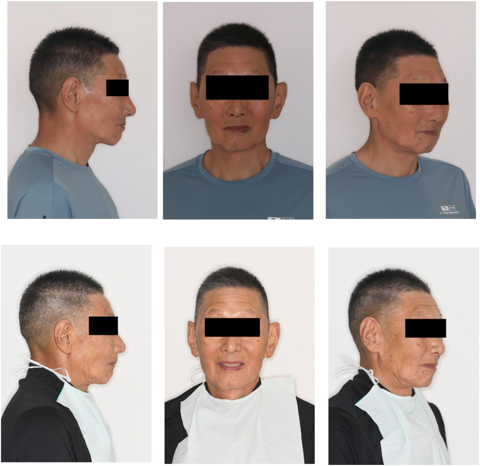 Two sets of three portrait photos, each showing the same man from the side, front, and another side view. The first row shows the man looking straight-faced, wearing a blue shirt. The second row shows him smiling, wearing a black jacket and a protective bib. His eyes are covered for privacy in all images.