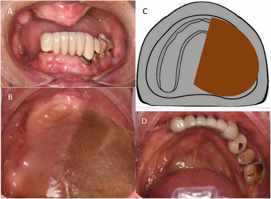 Four panels illustrating an edentulous maxilla and a hemimaxillectomy defect. Panel A: Maxillary arch with complete edentulism (no prosthesis). Panel B: Close-up of the palate on the defect side showing altered contour and mucosal color. Panel C: Schematic cross-section highlighting the resected area consistent with an Aramany class II defect. Panel D: Mandibular arch with partial edentulism and fixed restorations. The set documents anatomy relevant to denture design and retention.