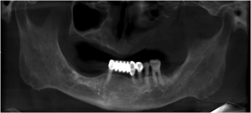 Maxillofacial imaging demonstrating a left hemimaxillary resection defect, including loss of alveolar bone and hard palate on the affected side. The image emphasizes the extent of resection, residual structures on the contralateral side, and limitations for conventional denture retention.