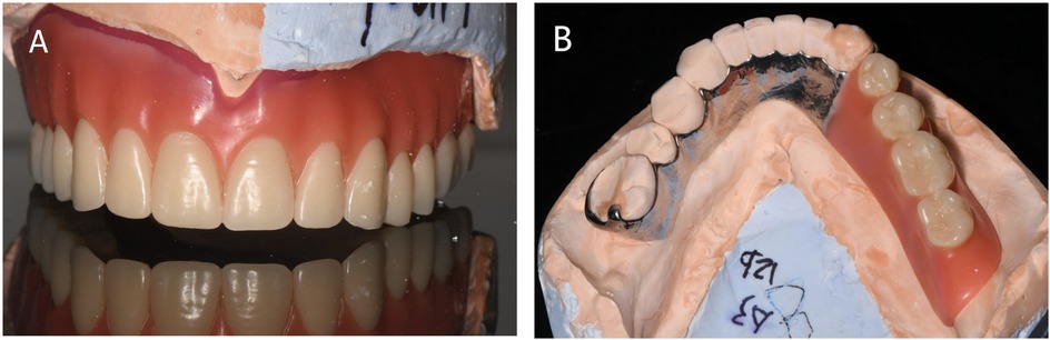 Two-panel figure illustrating the try-in and the opposing definitive prosthesis. Panel A: On the cast, an upper wax trial maxillary denture is shown to verify tooth arrangement, border extension, vertical dimension, and interarch/occlusal relationships. Panel B: The definitive mandibular denture is shown extraorally to display occlusal morphology, flange contour, and base extension.