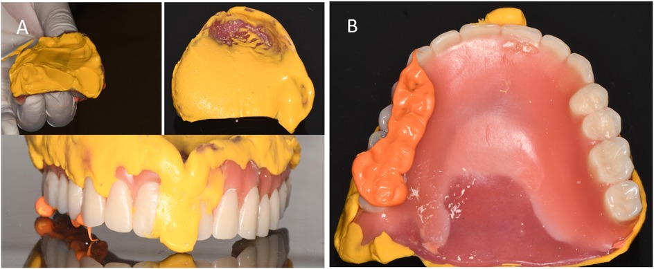 Dental impressions and models showing different stages of dental mold preparation. Panel A includes images of molds coated with a yellow material, highlighting the upper and lower teeth impressions. Panel B shows a dental model with artificial teeth, featuring an orange material on one side.