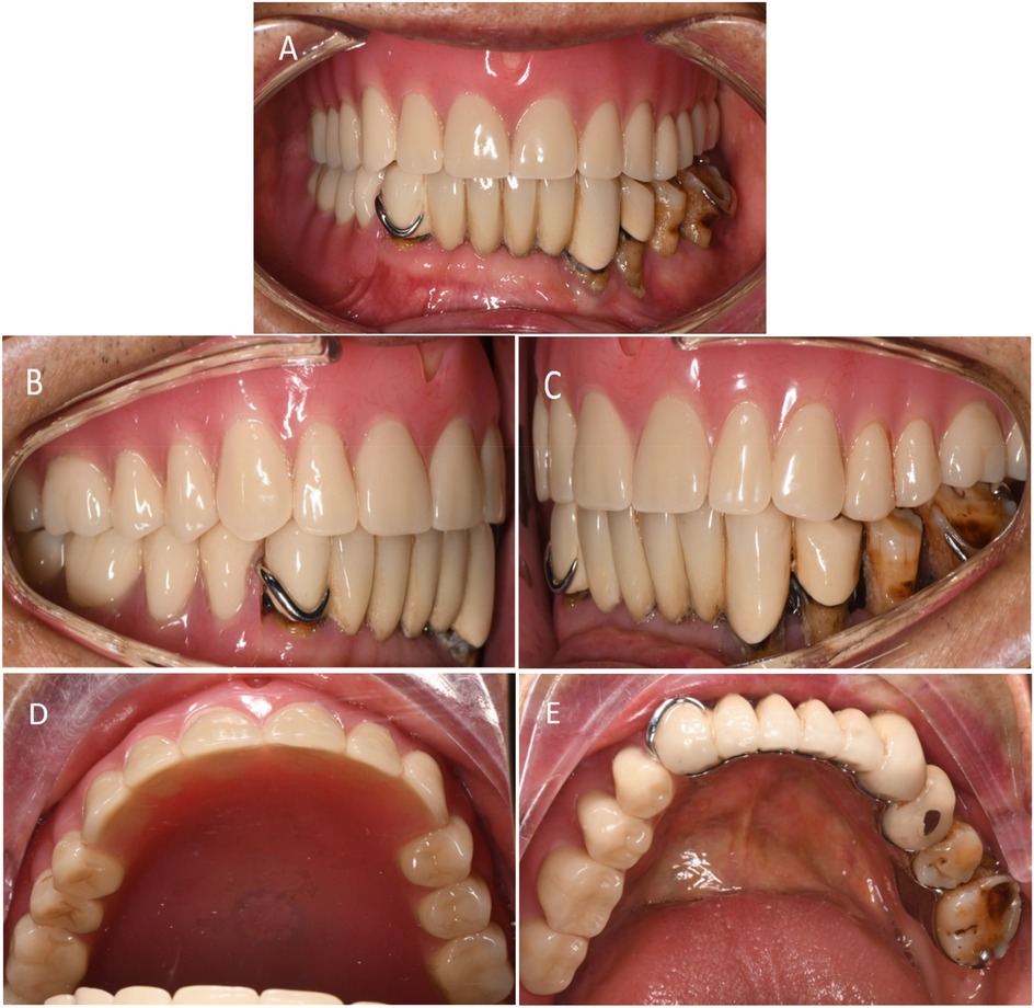 Five intraoral photographs documenting occlusion and arch views. A: Frontal occlusion with the denture in place. B–C: Left and right lateral views showing intercuspal contacts. D: Maxillary occlusal/arch view of the denture. E: Mandibular denture and arch view.