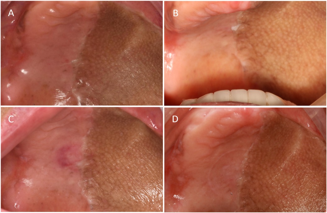 Four intraoral photographs (A–D) showing the palatal mucosa at the suction-site at baseline and follow-ups (1, 3, and 6 months). Panels illustrate color, surface texture, and indentation at the contact area. The series documents soft-tissue appearance over time under restricted-wear guidance.