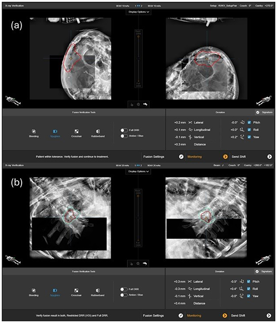 X-ray images showing two separate sessions, labeled (a) and (b). Both sets display cranial views with red outlines identifying specific areas of interest. Below each image, there are digital display options and fusion verification tools, including settings for blending, crosshair, and rubberband adjustments. Deviations are indicated with metrics for lateral, longitudinal, vertical, and distance measurements, as well as pitch, roll, and yaw angles. There are notifications for patient tolerance and verification requirements, and buttons for monitoring and sending shifts.