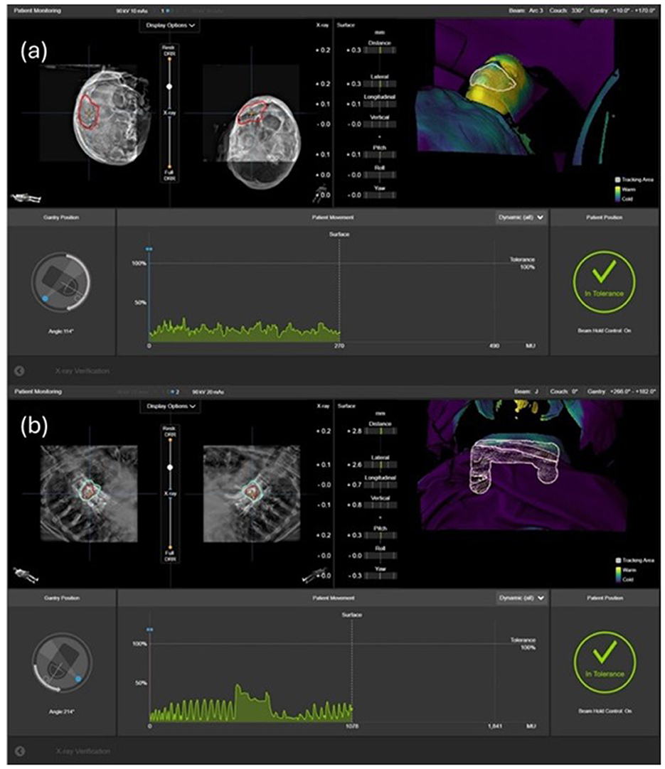 Two-part medical imaging display. (a) Shows a cranial scan with three images and a chart monitoring patient position. A green checkmark indicates “In Tolerance.” (b) Displays a thoracic scan of a patient with a similar layout. The position chart and green check are also present, indicating “In Tolerance.”