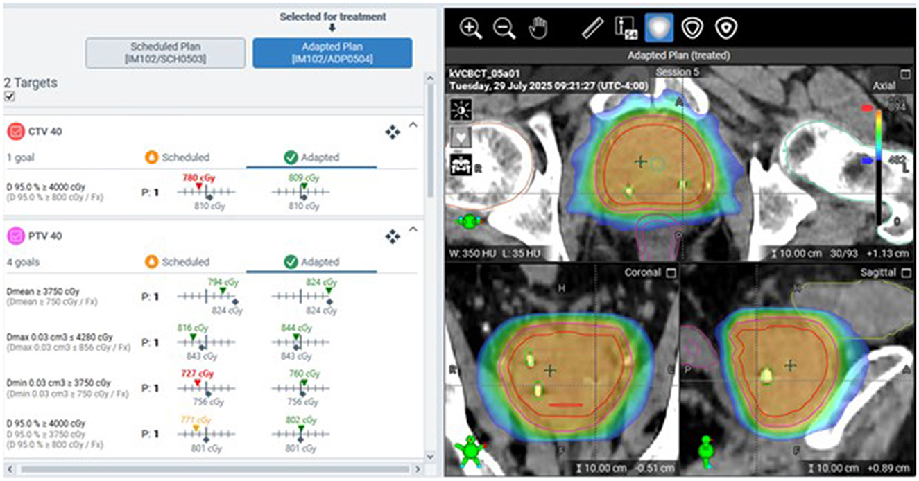 Medical imaging screenshot displaying treatment plans with adaptation details. The left section includes comparative data for scheduled and adapted plans targeting CTV and PTV, showing dose measurements and goals. The right section features axial, coronal, and sagittal MRI scans with colored overlays indicating treatment areas and dosages.