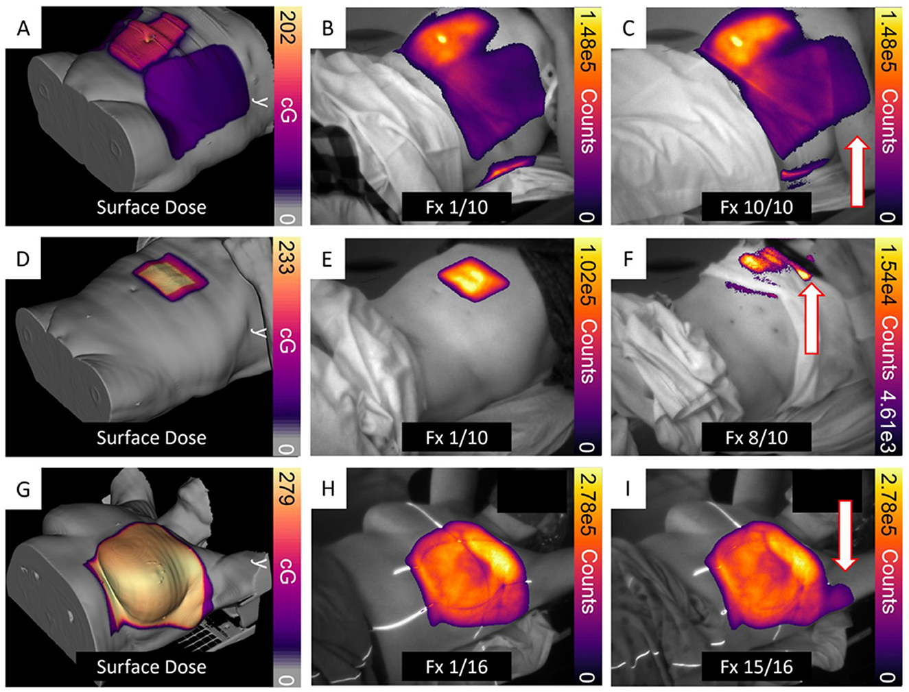 Medical imaging showing simulated surface doses and Cherenkov radiation scans on a patient's shoulder in nine panels labeled A to I. Panels A, D, and G display computer-generated 3D models with color maps indicating surface dose levels. Panels B, E, and H show corresponding infrared images with dose intensities marked as “Fx 1/10.” Panels C, F, and I also show infrared images, labeled “Fx 10/10,” “Fx 8/10,” and “Fx 15/16” respectively, with arrows indicating unintended dose to patient arm (Fig. C), hand (Fig. F), and axillary region (Fig. I). Each panel uses a color gradient to represent dose intensity, with scales varying across images.