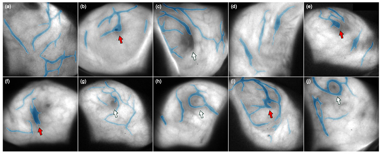 Visualization of segmented bio-morphological structures (in blue) derived from Cherenkov imaging (in black and white) in ten representative breast cancer patients.