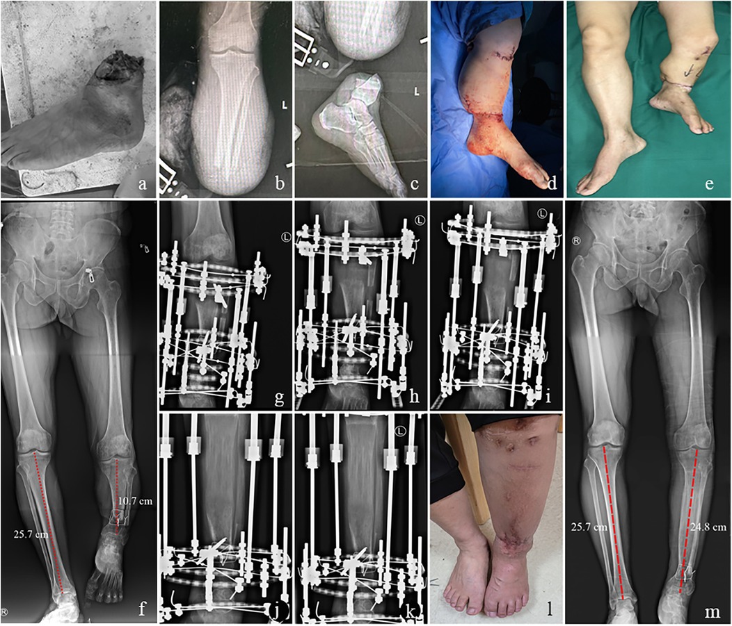 Series of medical images showing a foot with severe injury (a-c), post-surgical and healing stages (d-e), X-rays of legs with measurements (f, m) and external fixators (g-k), and healed leg (l).