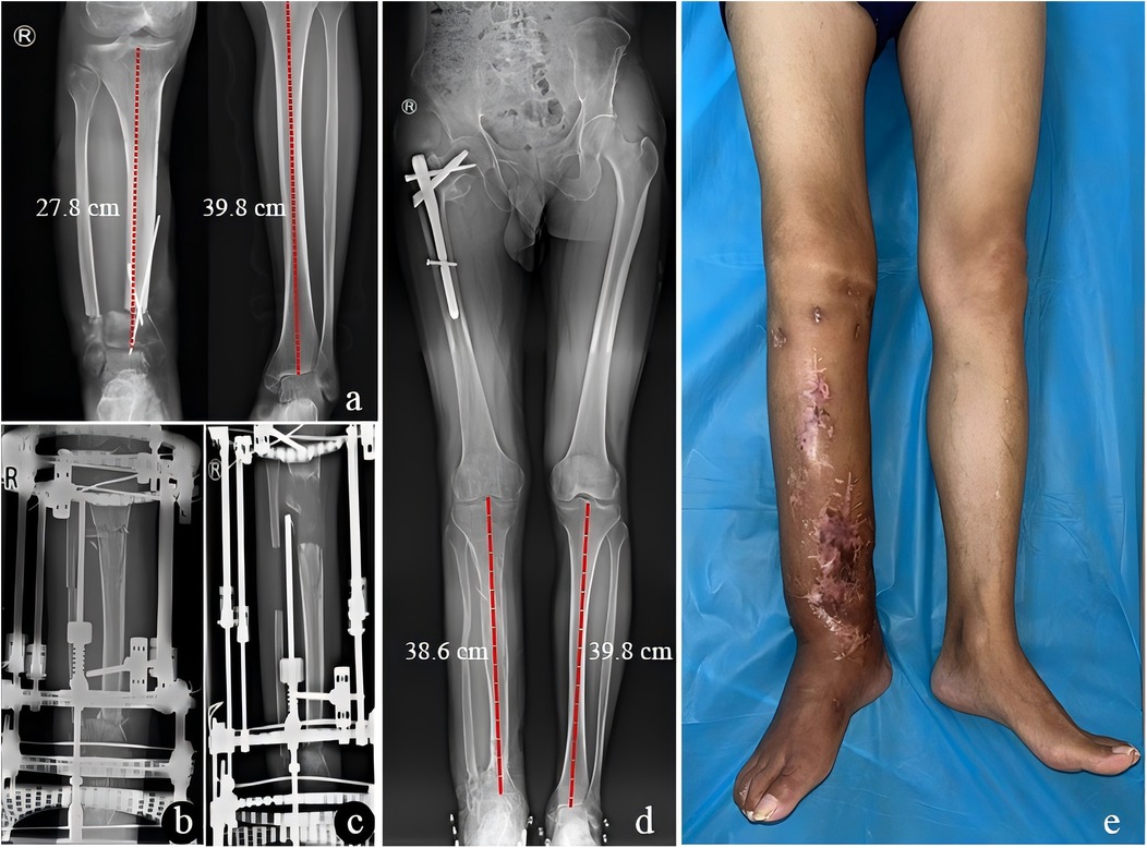 X-ray images and a photo of legs. The X-rays show orthopedic measurements with marked lines and instruments. The left X-ray indicates 27.8 cm and 39.8 cm measurements. The middle X-ray shows a hip with surgical pins. The right X-ray also displays a measurement of 38.6 cm and 39.8 cm. The photo shows a leg with visible scars and surgical marks standing on a blue surface.