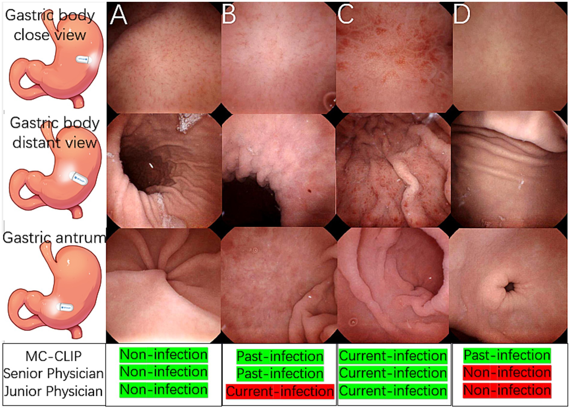 Endoscopic images of the stomach show four views: A, B, C, and D. Each column represents a different infection status: non-infection, past infection, and current infection, interpreted by MC-CLIP, senior, and junior physicians. The stomach illustrations on the left indicate views from the gastric body and antrum. Tables below list infection status with corresponding colors: green for non-infection, red for infection.