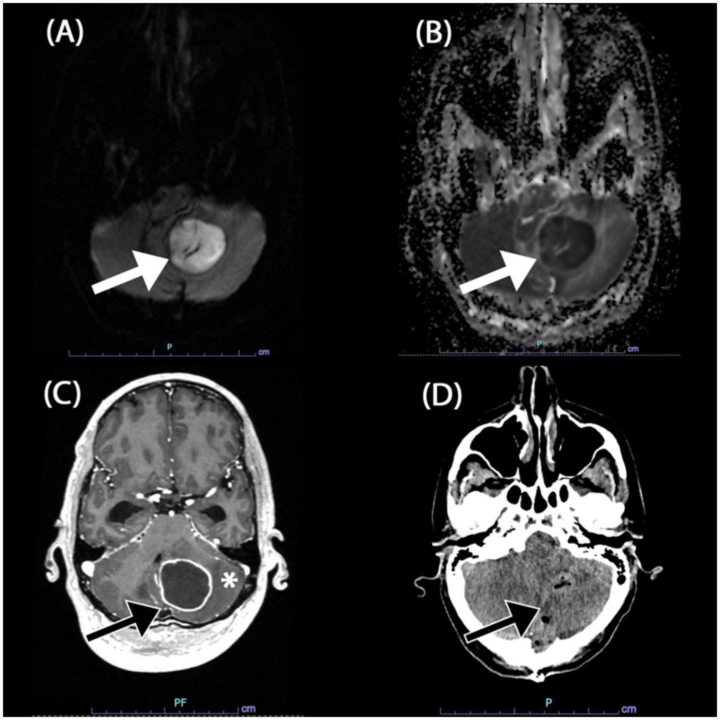 Magnetic resonance imaging of the brain with four sections labeled A to D. (A) shows a lesion with high signal intensity marked by a white arrow. (B) displays a similar area of change with the arrow indicating a dark region. (C) features an arrow pointing to a mass with an asterisk marking a central hypodense area. (D) highlights a hypodense lesion with a black arrow.