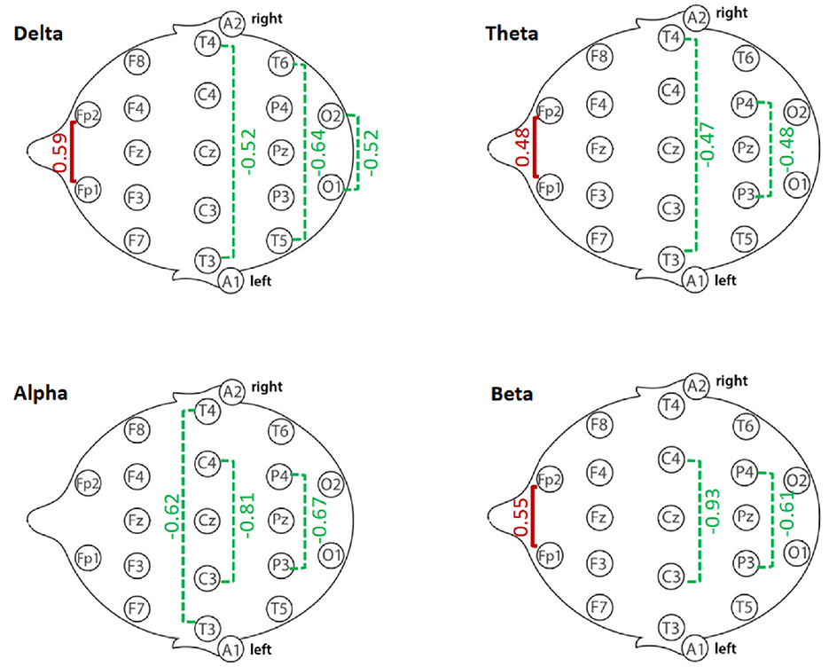 Four brain diagrams labeled Delta, Theta, Alpha, and Beta, each showing EEG electrode positions with numerical values. Delta shows values 0.59, -0.52, -0.64, -0.52. Theta displays values 0.48, -0.47, -0.48. Alpha indicates values 0.62, -0.81, -0.67. Beta has values 0.55, -0.63, -0.61. Each diagram corresponds to different brainwave frequencies.