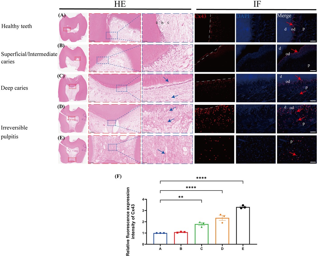 Histological and immunofluorescence images comparing five dental conditions: healthy teeth, superficial/intermediate caries, deep caries, and irreversible pulpitis. The left panel shows H&E stained sections with structural details indicated by blue arrows. The right panel displays Cx43 expression and DAPI staining, with merged images highlighting differences in expression levels across conditions. A bar graph (F) shows relative fluorescence expression intensity of Cx43, significantly increasing from healthy teeth to irreversible pulpitis with statistical annotations.