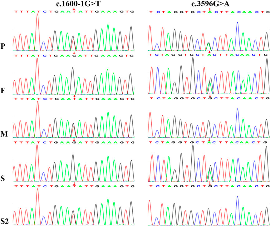 DNA sequencing chromatograms show genetic variations at two positions labeled c.1600-1G>T and c.3596G>A. The panels labeled P, F, M, S, and S2 display the sequencing peaks with indicated nucleotide changes by red arrows, illustrating genetic differences across samples.