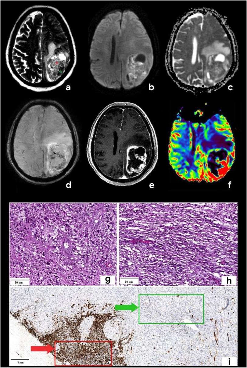 MRI and microscopic images show a brain tumor with labeled sections. Images (a)-(f) display different MRI techniques indicating tumor location and characteristics. Images (g) and (h) are histological slides showing tissue details at 10 micrometers. Image (i) highlights areas of interest with colored arrows and boxes at 4 micrometers.
