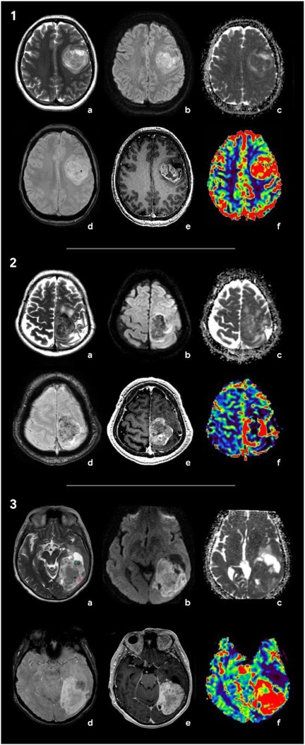 Three sets of brain scans, each with six MRIs labeled a to f. Each set shows different views and types of imaging techniques, including color-coded maps in the f panels, possibly reflecting perfusion or metabolic activity.