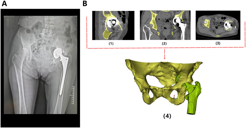 X-ray and medical imaging of a hip prosthesis. Image A shows a frontal X-ray with a hip implant. Image B includes three CT scan views: (1) sagittal, (2) coronal, and (3) axial, each highlighting the prosthetic. Below, image (4) is a 3D reconstruction of the pelvis and hip implant.