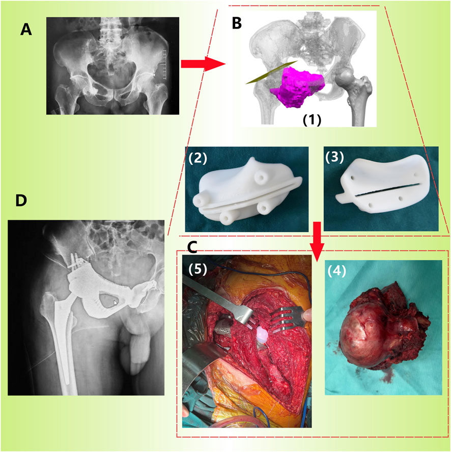 Medical illustration depicting a series of images related to hip surgery. Image A shows an X-ray of the pelvis. Image B features a 3D model of the hip with a highlighted purple area. Image 1 is a close-up of the highlighted area. Images 2 and 3 show views of a white surgical guide. Image C includes two sub-images: Image 4 shows a removed tumor or bone mass, and Image 5 displays an intraoperative view with surgical tools in use. Image D is another X-ray showing a hip prosthesis in place.
