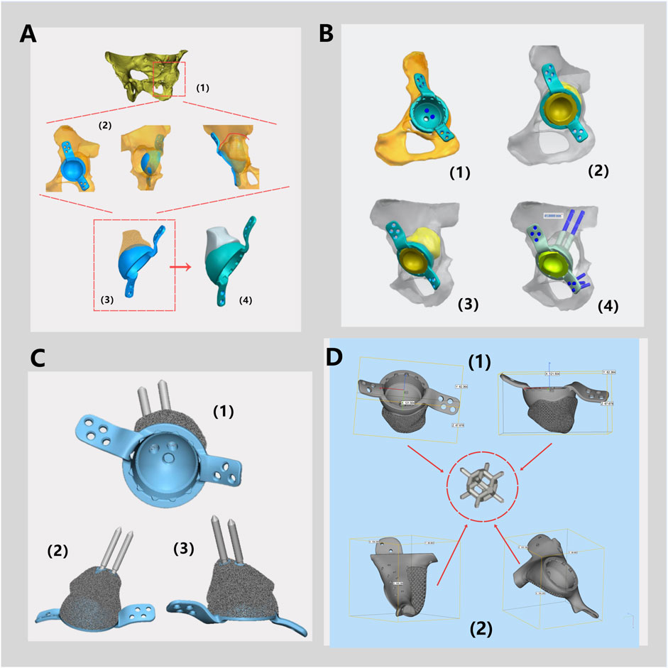 Panel A shows a sequence from a pelvic bone model to a custom implant design in steps one to four. Panel B displays four configurations of the implant integration on a bone. Panel C presents three views of the implant, highlighting its structural elements. Panel D provides measurements and angles of the implant, with a central focus on a specific component.