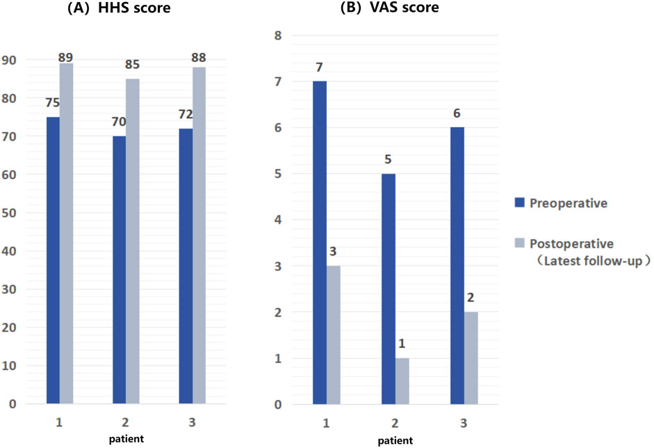 Bar charts comparing preoperative and postoperative scores for three patients. Chart (A) shows HHS scores: Patient 1 improved from 75 to 89, Patient 2 from 70 to 85, Patient 3 from 72 to 88. Chart (B) shows VAS scores: Patient 1 decreased from 7 to 3, Patient 2 from 5 to 1, Patient 3 from 6 to 2.