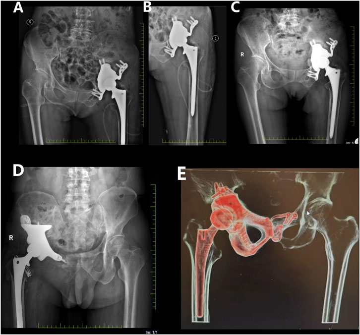 X-ray and scan images display various views of hip joint prostheses. Panels A, B, C, and D show different angles and placements of artificial hip joints in black and white. Panel E presents a colored scan highlighting bone structures with a hip prosthesis visually emphasized in red. Each panel offers a distinct perspective on prosthesis positioning and integration with the skeletal system.