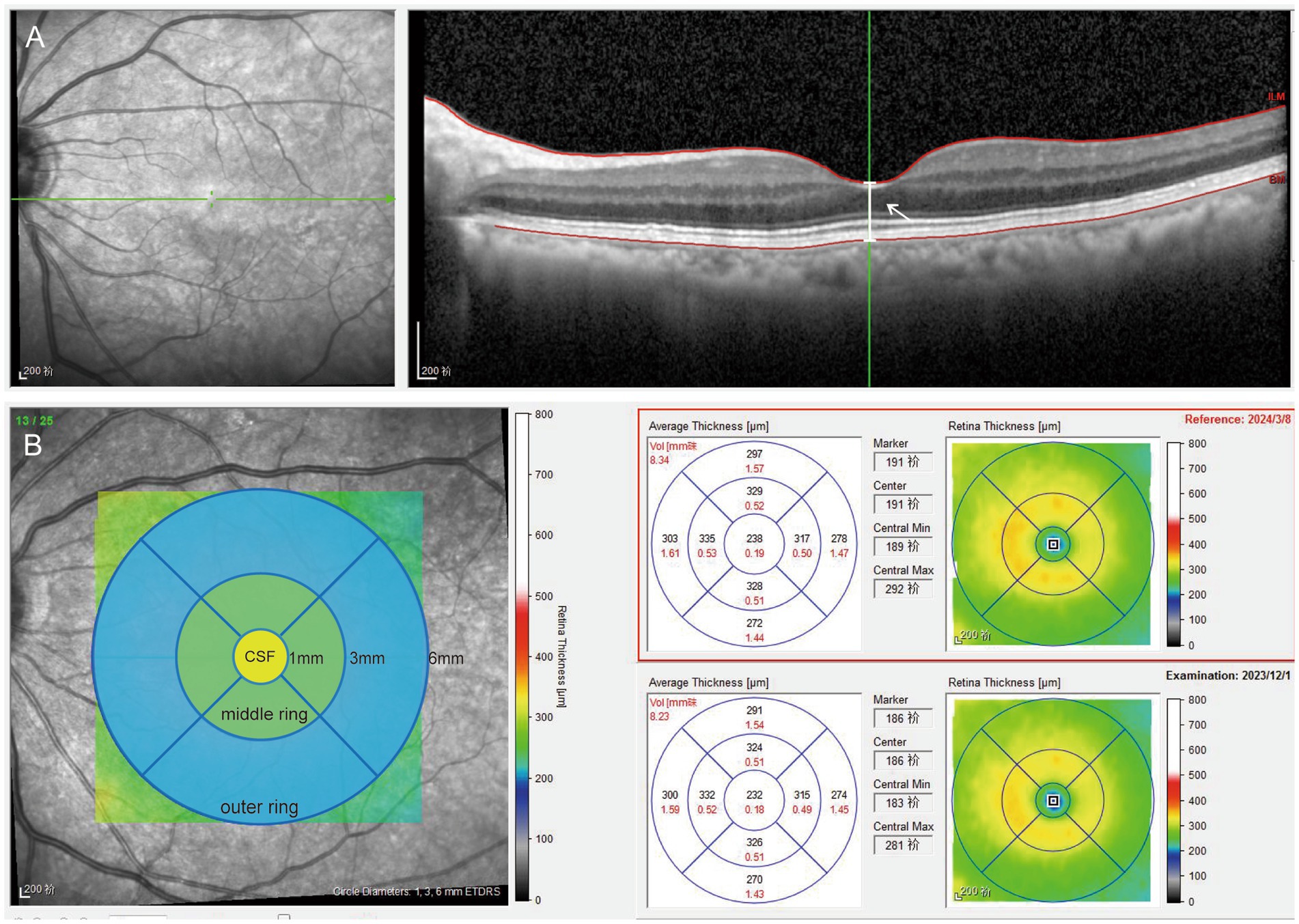 Retinal imaging showing a comparative analysis of macular thickness. Image A includes black-and-white retinal scans and cross-sectional imagery with highlighted layers. Image B presents a color-coded map of retinal thickness, with zones labeled CSF, middle ring, and outer ring. Accompanying graphs display average retinal thickness measurements in micrometers for two dates, March 8, 2024, and December 1, 2023.