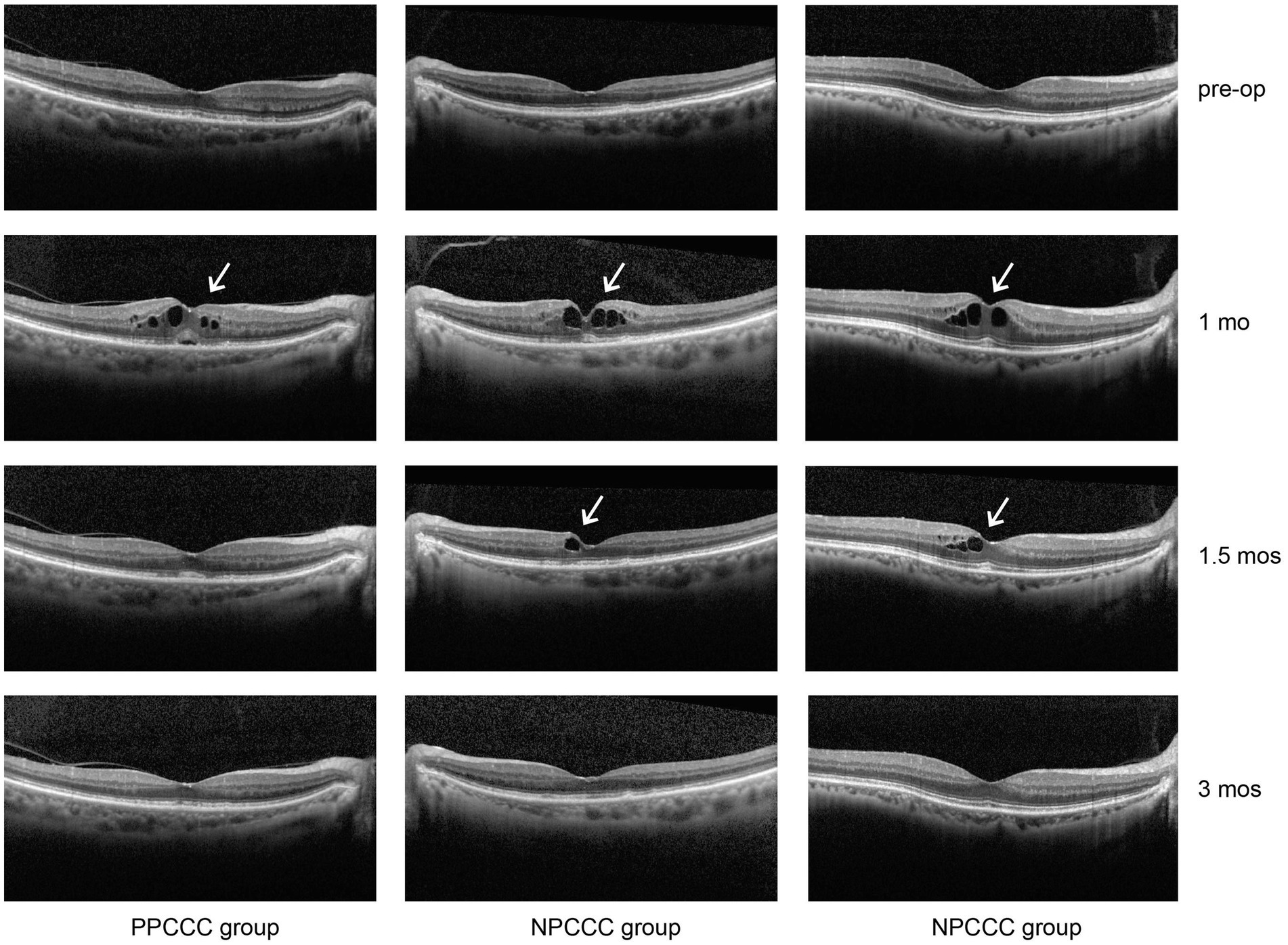 Three columns of retinal OCT images showing changes over time for two groups. The first column represents the PPCCC group at pre-op, one month, one and a half months, and three months. The second and third columns show the NPCCC group at the same intervals. Arrows indicate significant changes at one month and one and a half months. Each row compares similar timeframes across the groups.