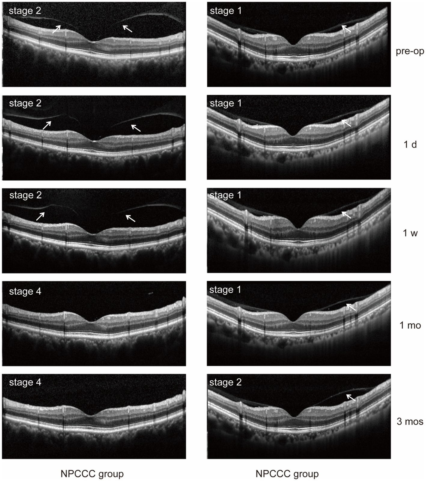 Sequential optical coherence tomography (OCT) images show retinal changes in NPCCC and NPCCC groups from pre-operation to three months post-operation. Each group has images labeled by stage and time: pre-op, one day, one week, one month, and three months. Arrows indicate specific retinal layers affected in stages one to four, showing progression and changes over time.