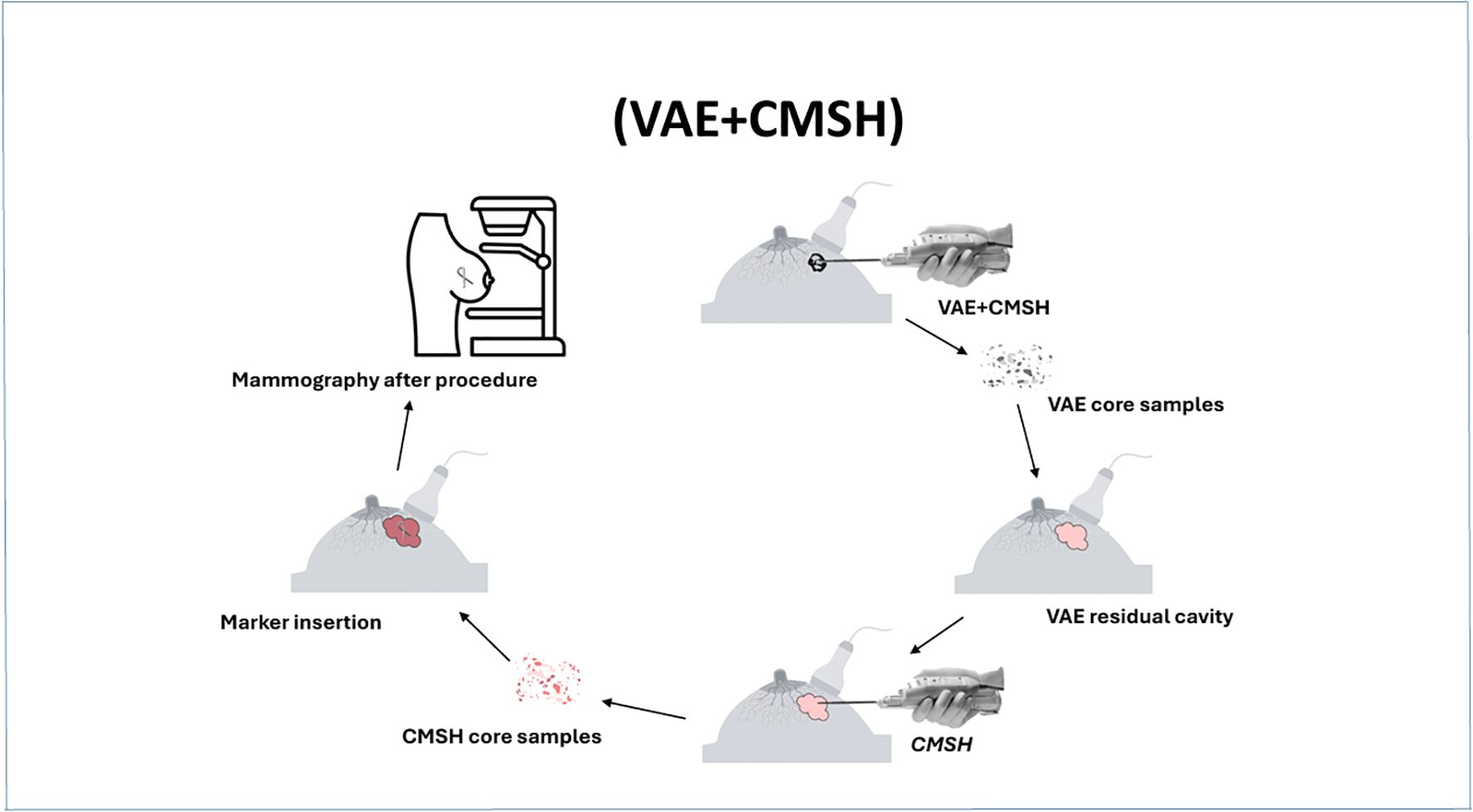 Diagram illustrating a procedure sequence labeled VAE+CMSH. It shows the process of obtaining VAE core samples leading to the formation of a VAE residual cavity. Subsequently, CMSH core samples are extracted. A marker insertion follows, and ends with a mammography to evaluate the procedure. Arrows connect each step, indicating the flow of the process.
