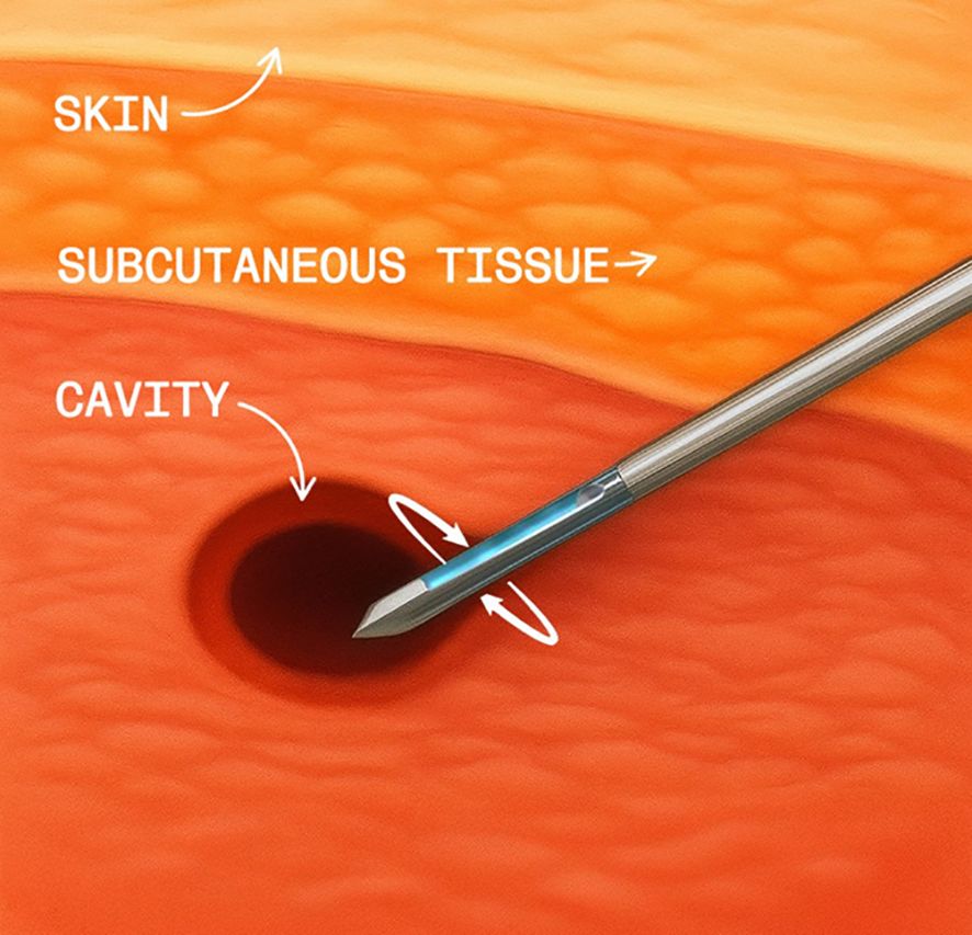 Illustration of a skin cross-section showing labeled layers: skin, subcutaneous tissue, and a cavity. A tool with a pointed end is shown rotating within the cavity, indicating a procedure or biopsy.