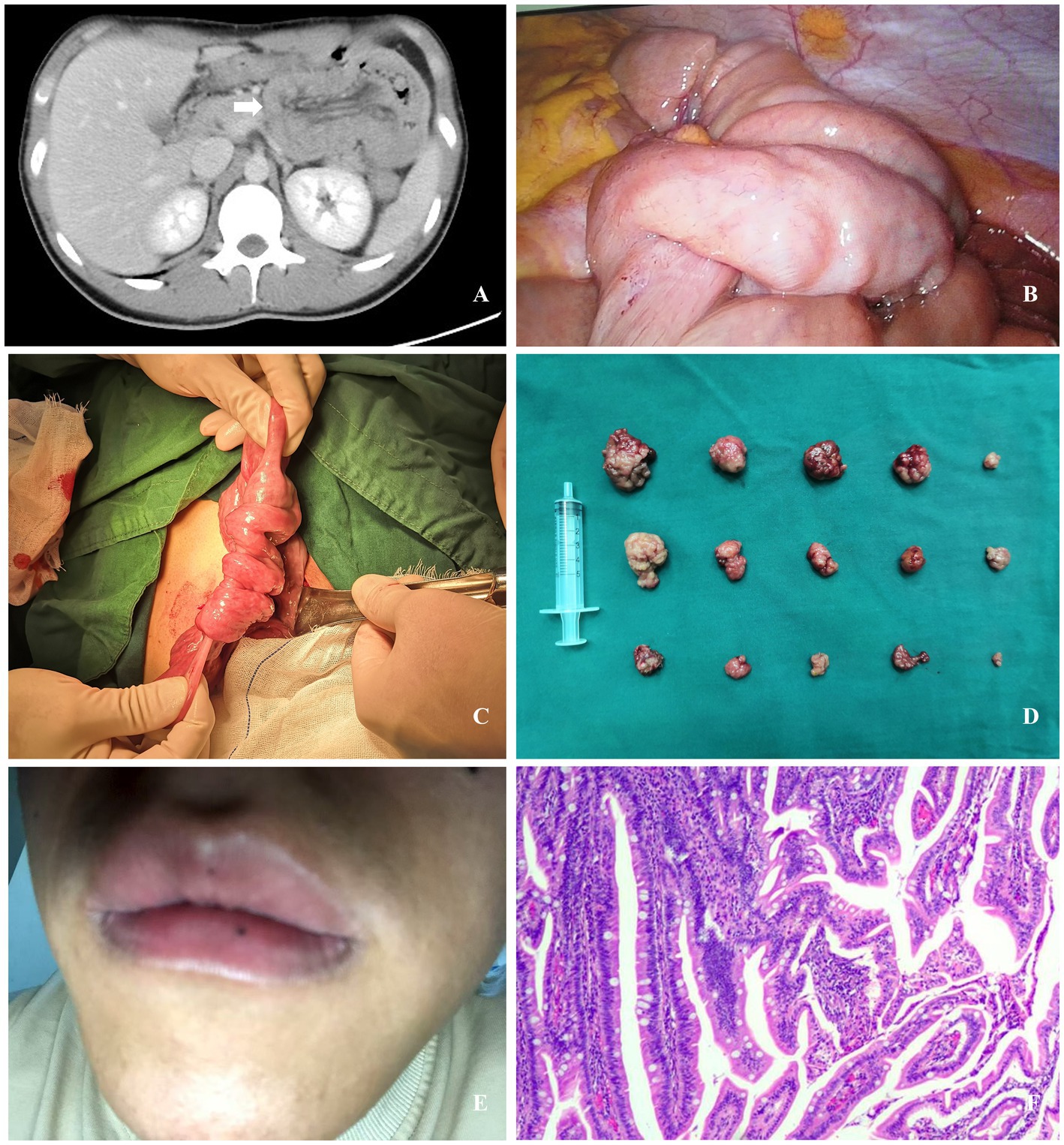 Medical collage comprising six images: A) CT scan showing an abdominal region with an arrow indicating a specific area. B) Intraoperative view of intestines. C) Surgical procedure displaying a section of the twisted intestine. D) Multiple excised masses alongside a syringe on a green surface. E) Close-up of a person's swollen lips with a small dark mark. F) Microscopic view of tissue with irregular patterns, likely indicating abnormal cell structure.