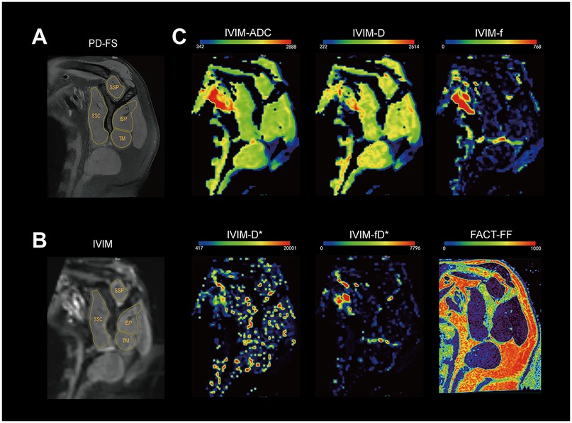 MRI images display shoulder anatomy, labeled in panels A and B with structures such as SSP, SSC, ISP, and TM. Panel C shows various diffusion maps: IVIM-ADC, IVIM-D, IVIM-f, IVIM-D*, IVIM-fD*, and FACT-FF, using color scales to represent measurement values.