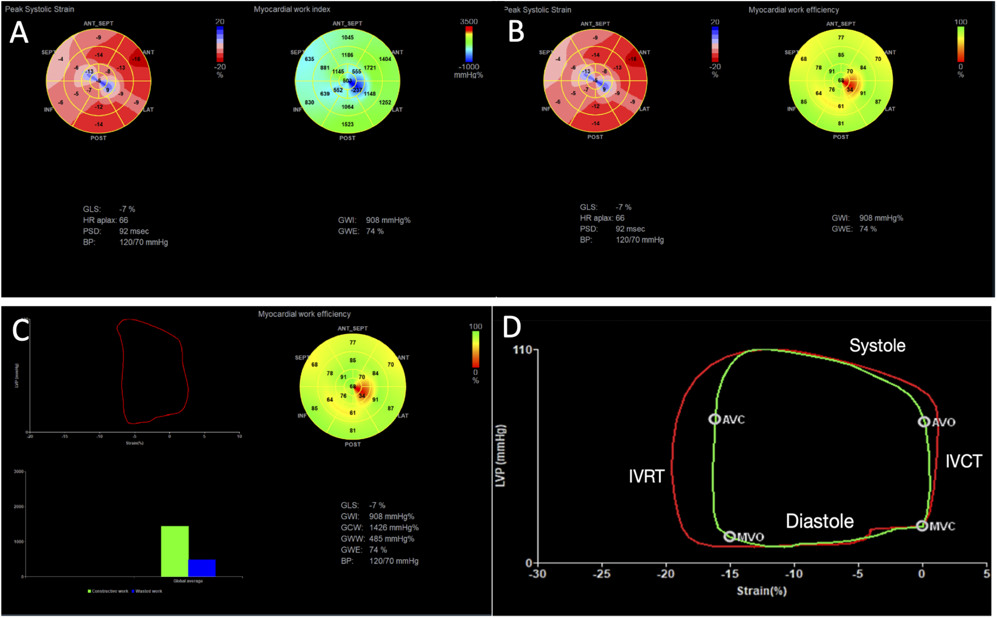 Four-panel image depicting cardiac function analysis. Panel A shows diagrams of peak systolic strain and myocardial work index with values and a color gradient from red to blue. Panel B displays similar diagrams with detailed myocardial work efficiency. Panel C includes a chart with a red curve labeled \"LVP\" vs. \"Strain (%)\" and bar graphs comparing constructive and wasted work. Panel D features a pressure-strain loop labeled with phases of the cardiac cycle: Systole, Diastole, Isovolumetric Contraction Time (IVCT), and Isovolumetric Relaxation Time (IVRT) with annotations at specific points.