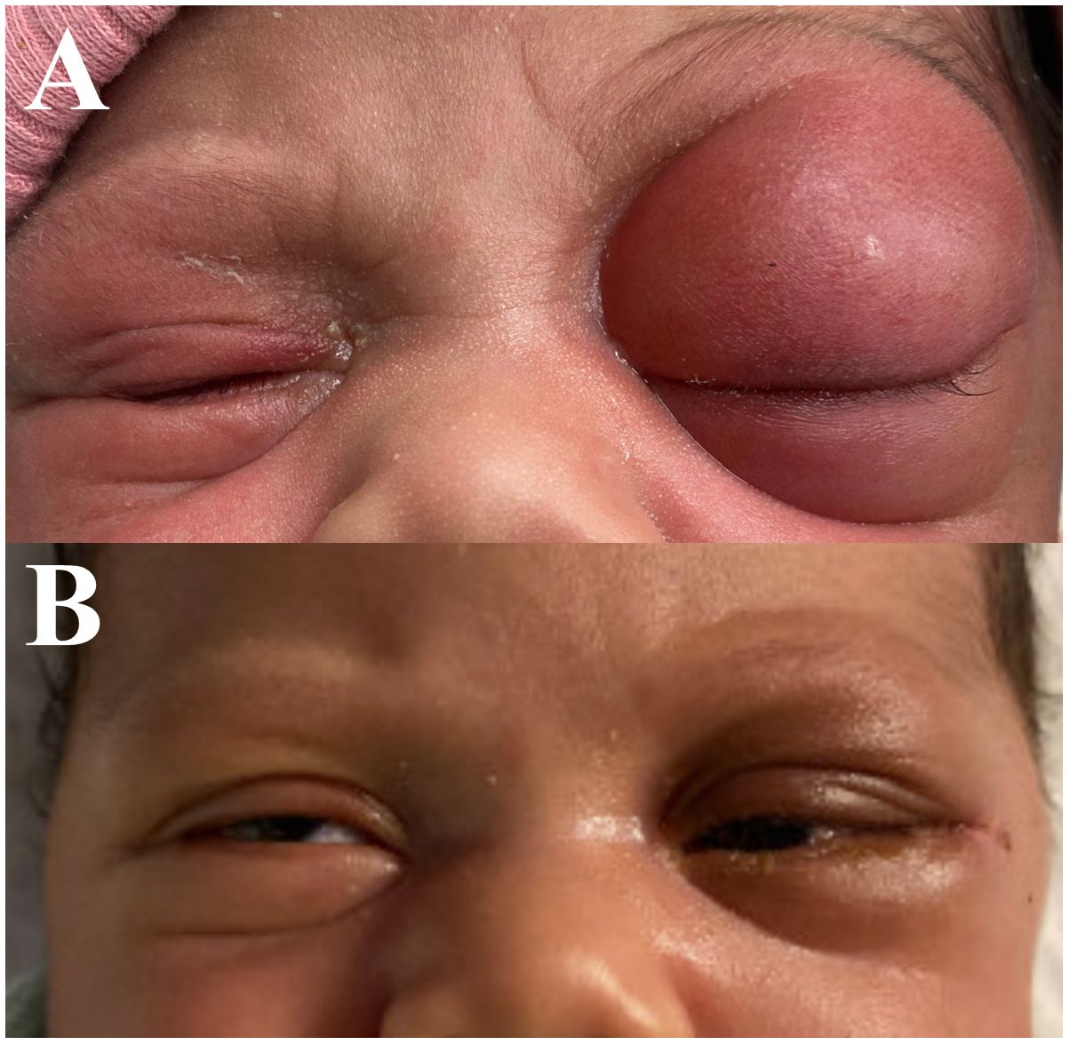 Close-up images of an infant's eyes. Panel A shows significant swelling and redness around the right eye. Panel B shows the same eye with reduced swelling, appearing more open and less inflamed.
